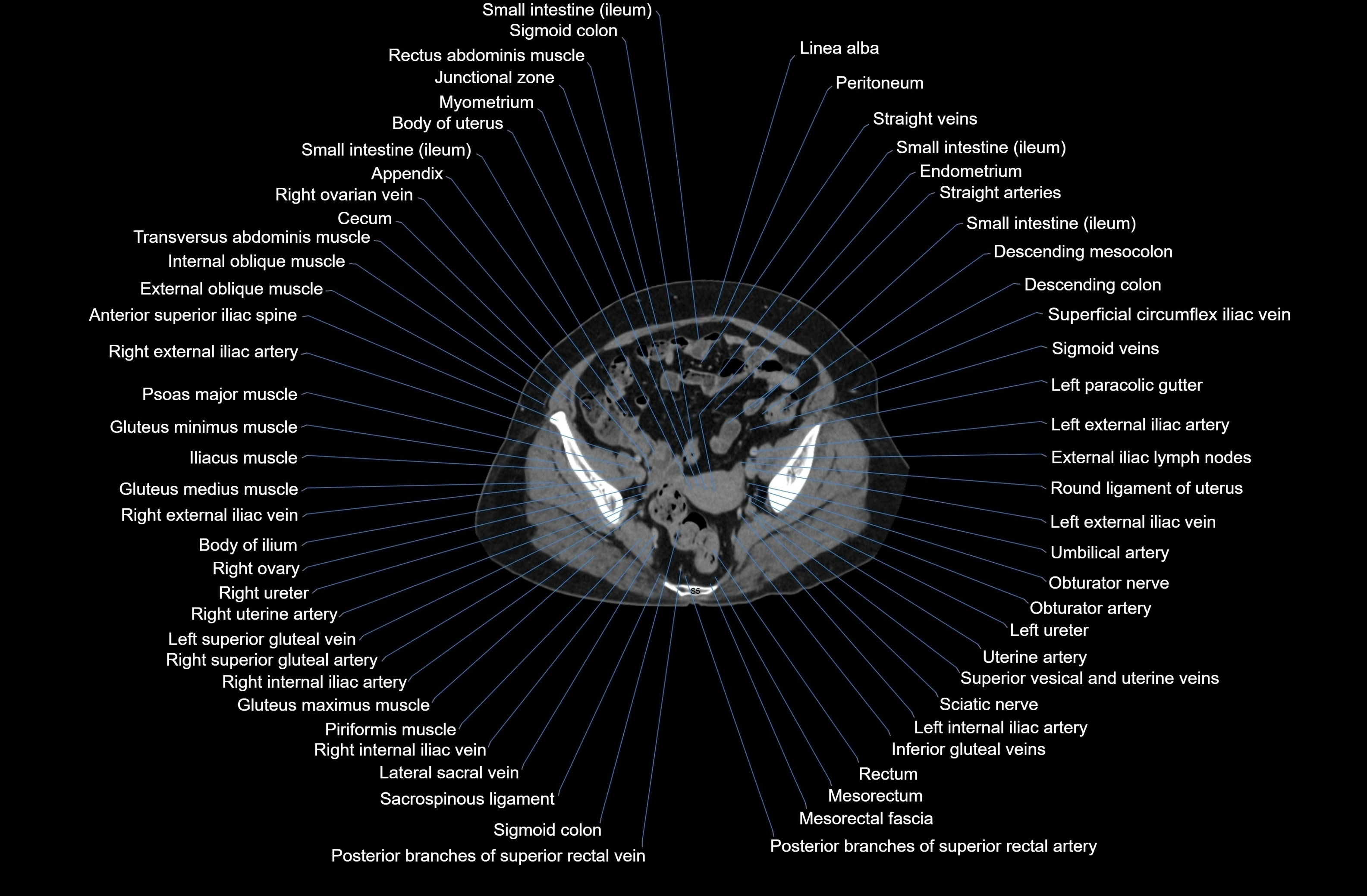 CT Abdomen axial cross sectional anatomy labelled radiology image-00079.webp